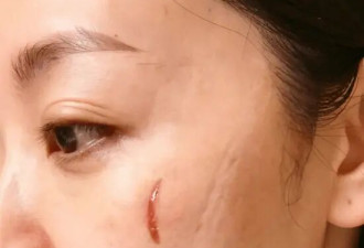 44岁杨蓉近况曝光！晒面部烫伤恢复照片上热搜，如今还是单身让人唏嘘