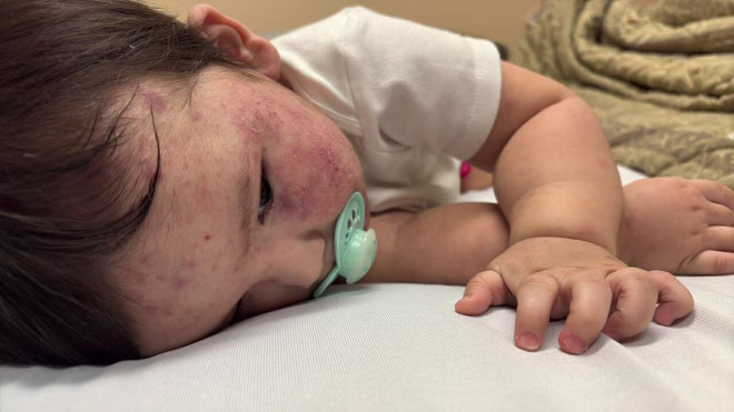 孩子脸部特写，脸上明显有红紫色斑块，正躺着