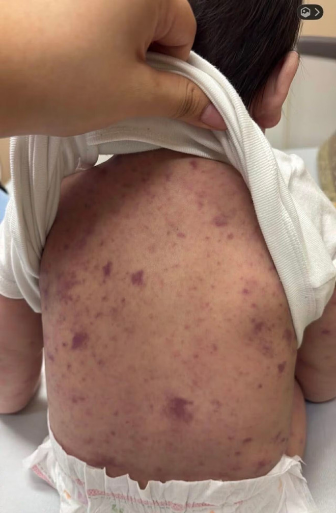 一只手掀起婴儿衣服，露出皮肤上密集红紫色斑点