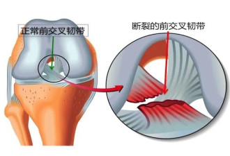 绝对不正常：魁北克年轻人膝盖手术激增，75%的病人会哭