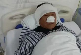 震惊！70岁老人与歹徒搏斗被咬掉鼻子还吞入肚中