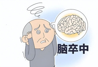 脑卒中二三十岁的人也可能中招 可防可治
