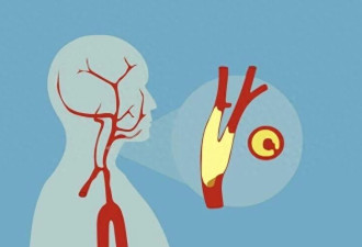 你的血管正悄悄“生锈” 你却浑然不觉？
