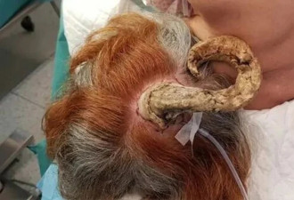 邪灵附身？ 75岁妇头长“恶魔角” 就医结果出炉