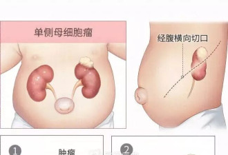 6岁女孩患癌 残酷真相面前爸妈决定：为她冻卵