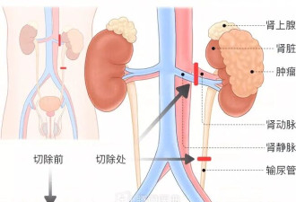6岁女孩患癌 残酷真相面前爸妈决定：为她冻卵