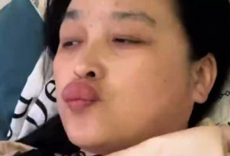 宝宝有脚气！外婆不听劝亲小脚 嘴唇感染肿成香肠