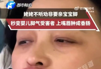 宝宝有脚气！外婆不听劝亲小脚 嘴唇感染肿成香肠