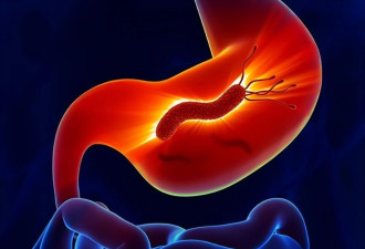 5类症状别硬扛 你的胃，是怎么一步步癌变？