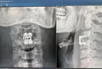 男子按摩正骨胸部以下瞬间失去知觉,可能终身残疾