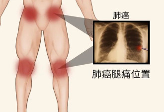 肺癌来临，腿部先知？