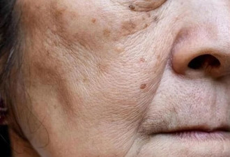 为什么有人满脸老年 有人却干干净净? 医生透实情