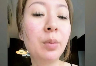 庄思敏惊爆出严重红疹，恐怖近照曝光面部蔓延至颈部：好痛苦啊！