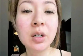 庄思敏惊爆出严重红疹，恐怖近照曝光面部蔓延至颈部：好痛苦啊！