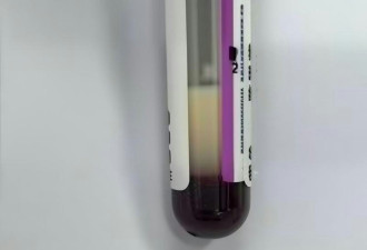 深圳女日饮4杯奶茶 血液现“乳白色” 送ICU险死