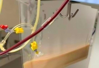 深圳女日饮4杯奶茶 血液现“乳白色” 送ICU险死