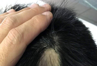一觉醒来 头发秃一块 医生：3类人风险最高