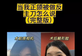 24岁女子做正颌手术后 自嘲“像朱元璋” 医生：比术前更洋气