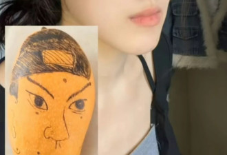 24岁女子做正颌手术后 自嘲“像朱元璋” 医生：比术前更洋气