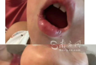 中山3岁童遭幼儿园老师暴力喂食 涉事老师被拘留