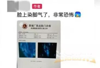 男子健身后脸上染"脚气"，直呼太恐怖！多人曾中招