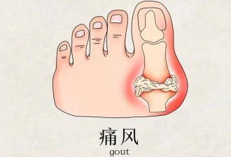 痛风为啥盯上你？年轻人5个习惯易患病