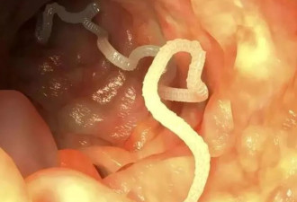 英国一女性游印度3个月 脑中竟藏38只寄生虫