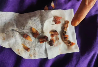 63岁心梗老人去看一颗牙，医院拔了12颗种10颗