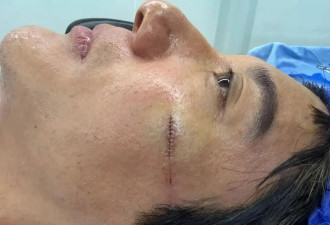 王力宏治疗摔伤细节曝光,去的医美科找的顶级专家