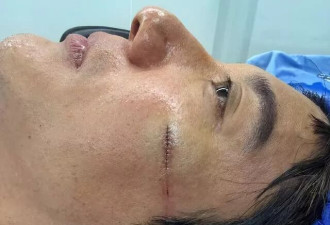 王力宏缝39针后报平安：14个月3起舞台事故