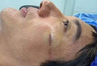王力宏缝39针!陈奕迅曾撞伤下体,演唱会事故太邪门
