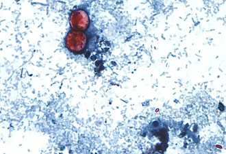 美酿“爆炸性腹泻” 数千人感染 蔓延32州