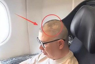 冯小刚终被曝脑袋全是斑块,养女徐朵脸肿原因藏不住了