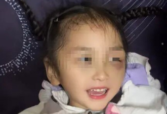 3岁女童疑被生父女友捂死，生前还遭遇骨折、烫伤