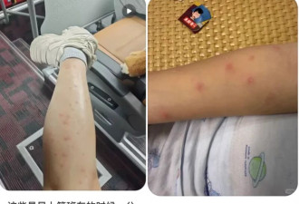 身上出现这种包 千万别挠! 比蚊子还毒啊