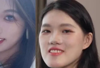 24岁女做正腭手术变“地包天”鞋拔子脸 医生：我喜欢，比较洋气