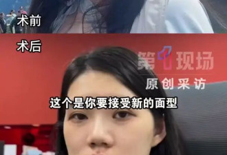 整形成“鞋拔子脸” 手术医生竟赞“洋气”